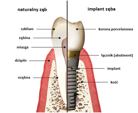 budowa implantu zęba