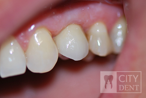 Stan po zacementowaniu korony porcelanowej na implancie w miejsce brakującego zęba czwartego w szczęce górnej.