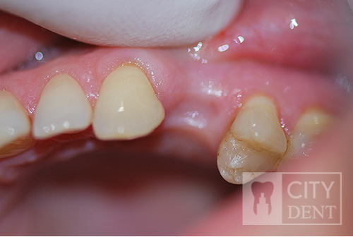 Brak zęba – czwórki górnej, stan po usunięciu.