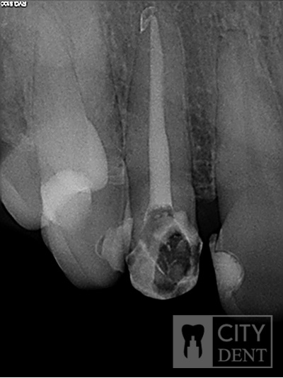 stan po wypełnieniu kanału, zakończone leczenie endodontyczne, ząb przygotowany do rekonstrukcji i leczenia protetycznego