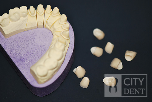 Gotowe korony oraz model roboczy zębów